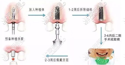 種植牙步驟示意圖