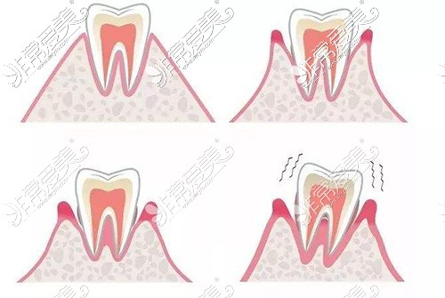 牙龈萎缩图示