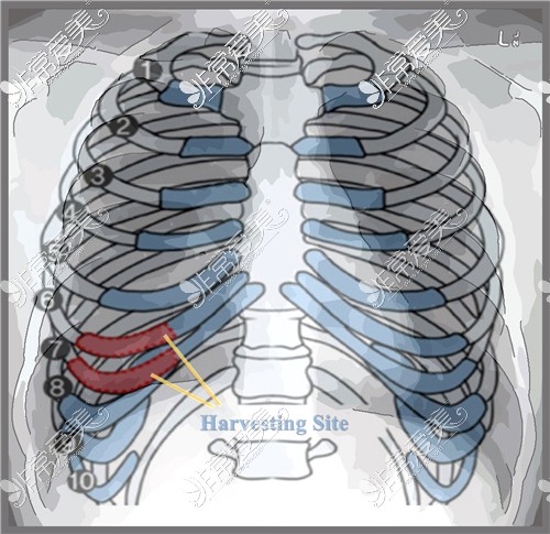 取肋骨示意图