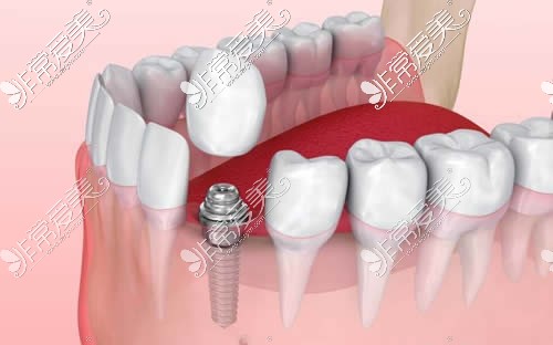门牙做种植牙卡通图
