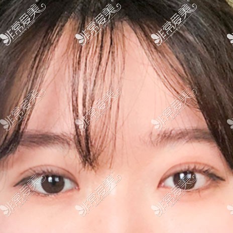 韩国yellow整形双眼皮整形照片