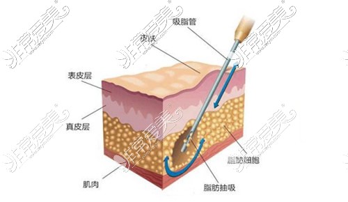 吸脂手术示意图