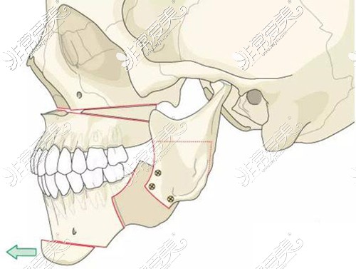 双鄂手术示意图