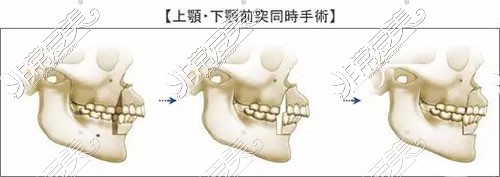 上颚下颚前突同时手术示意图
