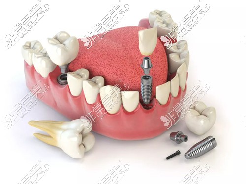 种植牙术后护理也非常重要
