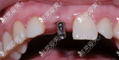 MS系列种植牙适合前牙
