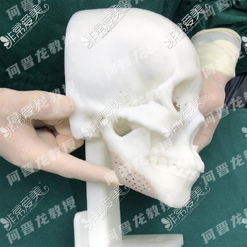 上海时光整形外科下颌角补骨模型