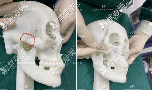 上海时光整形外科颧骨修复模型