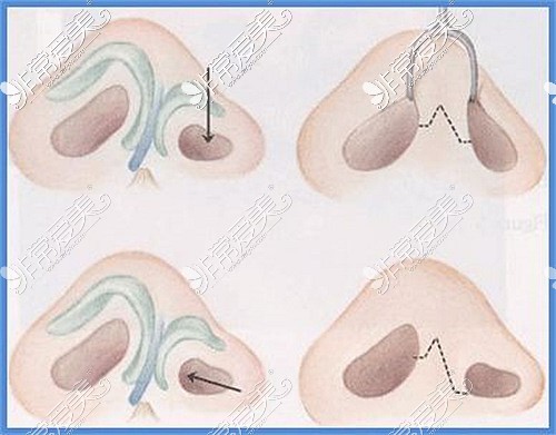 四川米蘭柏羽整形唇裂修復(fù)技術(shù)