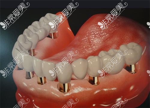 全口种植牙示意图