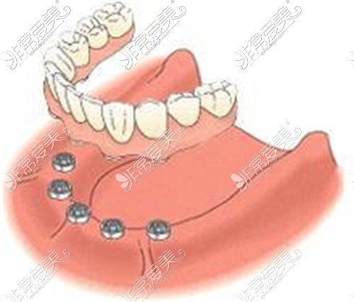 半口种植牙示意图