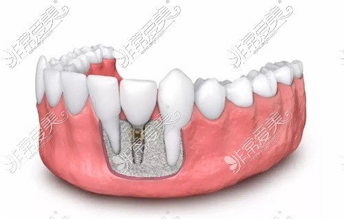 种植牙示意图