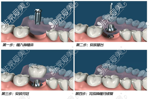 牙齿种植过程