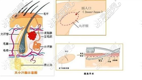 四川华美紫馨医学美容医院狐臭手术卡通图