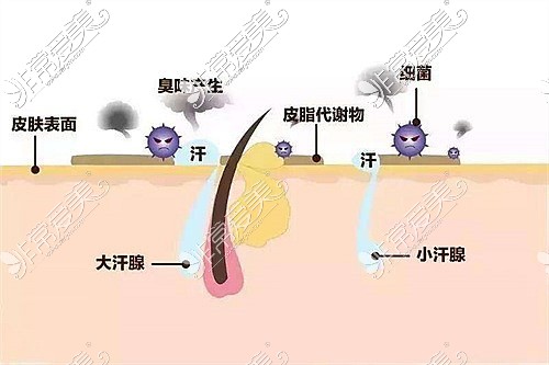 狐臭患者皮肤表面卡通图