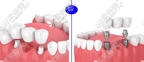 缺失一颗牙和缺失三颗牙搭桥修复对比