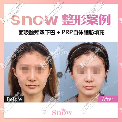 snow整形面部吸脂對比照