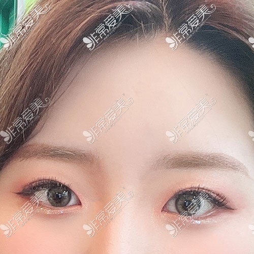 韩国yellow双眼皮手术前照片