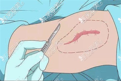 剖腹产疤痕祛除手术