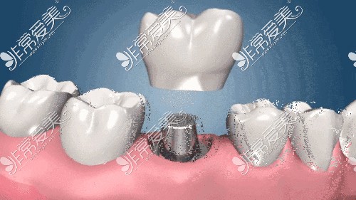 种植牙三期戴牙冠