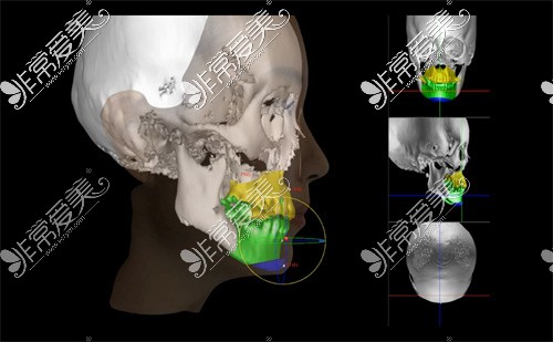 正颌手术CT图