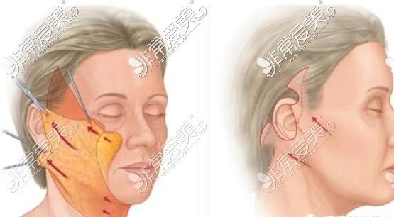 拉皮手术展示图