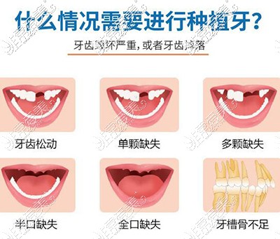 哪些問題要做全口種植改善