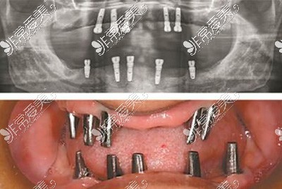 全口种植牙改善治疗展示