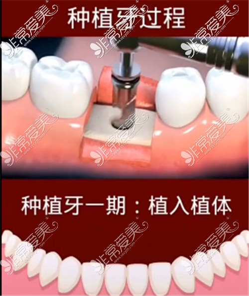 种植牙手术一期流程