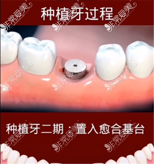 种植牙二期流程