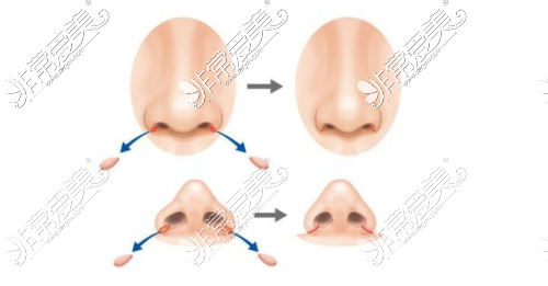 鼻翼缩小示意图
