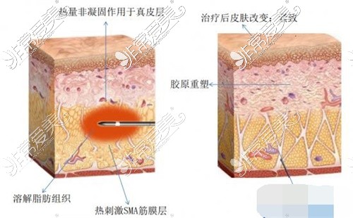 黄金微雕原理