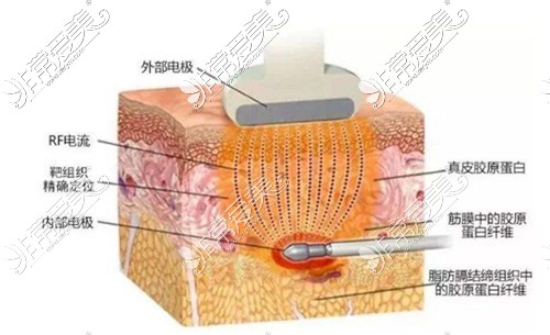 贵阳面部吸脂黄金微雕哪家做的好？黄金微雕做一次多少钱