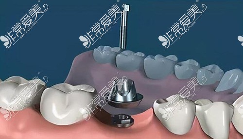 种植牙改善治疗过程