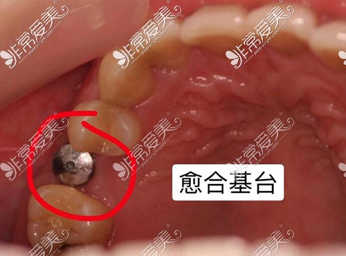 种植牙二期手术过程图片