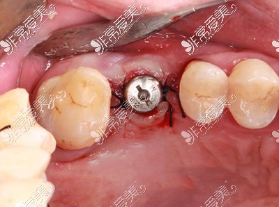 种植牙二期手术过程图解分享种牙二期比一期更痛是真的