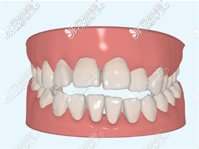 健康牙齿模型