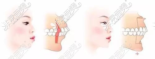 骨性凸嘴手术示意图