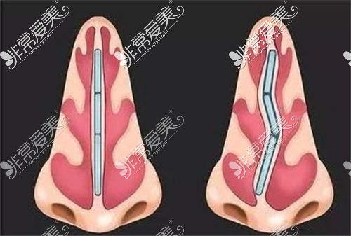 唇腭裂對鼻骨的影響