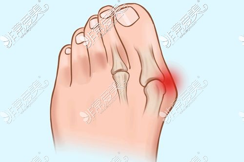 瀋陽大腳骨手術哪裡好拇指外翻找這兩家醫院正規可矯正