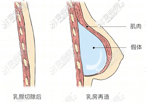 乳房再造术示意图