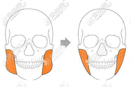 咬肌切除手术示意图
