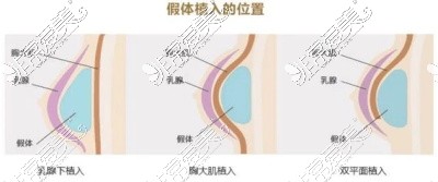 新疆华美医院隆胸示意图