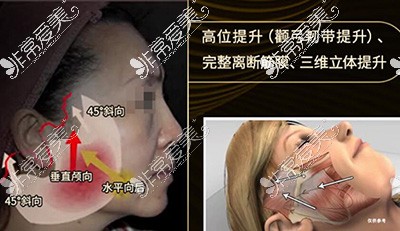 黄广香SMAS提升除皱术照片展示