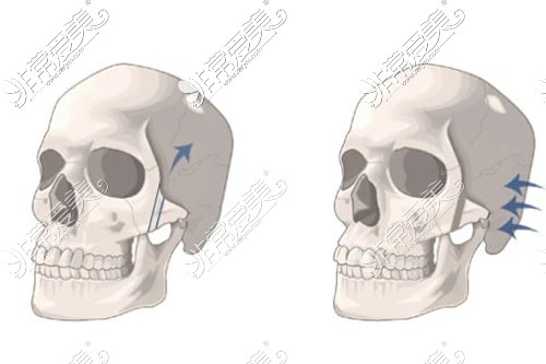顴骨手術(shù)示意圖