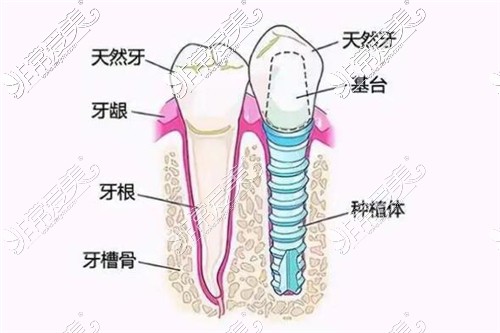 种植牙和牙齿对比图