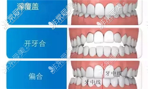 三种常见牙齿畸形