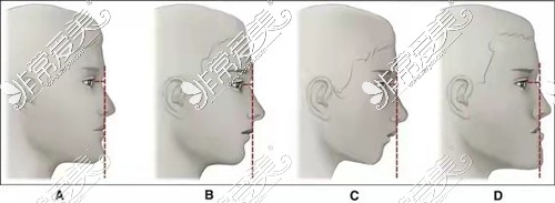 骨性错颌畸形侧面容貌程度对比