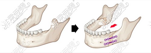 正颌手术3D图示