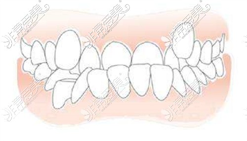 地包天牙齿排列情况